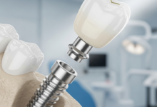 A highly detailed, photorealistic image of a dental implant. It clearly shows the titanium screw-like post partially embedded in a conceptual jawbone, a connecting abutment above it, and a perfectly shaped, natural-looking white ceramic tooth crown securely placed on top. The background is a softly blurred, clean, and modern dental clinic setting.